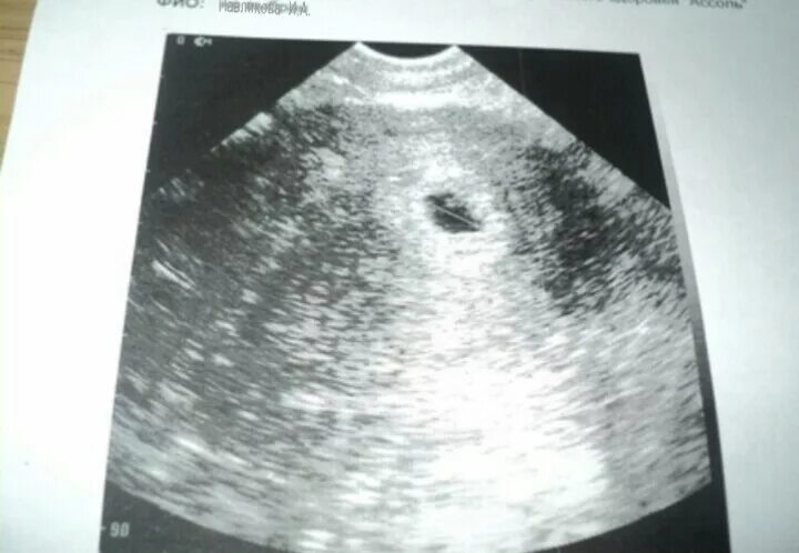 Эмбрион на 2 неделе беременности. Беременность 2-3 недели фото плода УЗИ. Снимок УЗИ 2-3 недели беременности. Фото УЗИ на 2 недели беременности от зачатия плода.