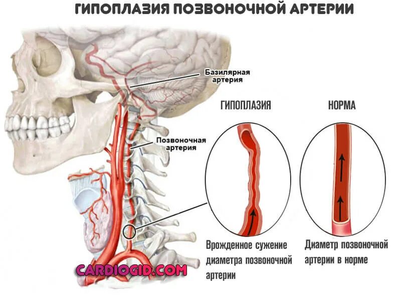 Причины сужения сосудов головного. Гипоплазия v4 сегмента правой позвоночной артерии. Гипоплазия позвоночной артерии диаметр сосуда. Гипоплазия v4 сегмента левой позвоночной артерии. Гиперплазия позвоночной артерии.