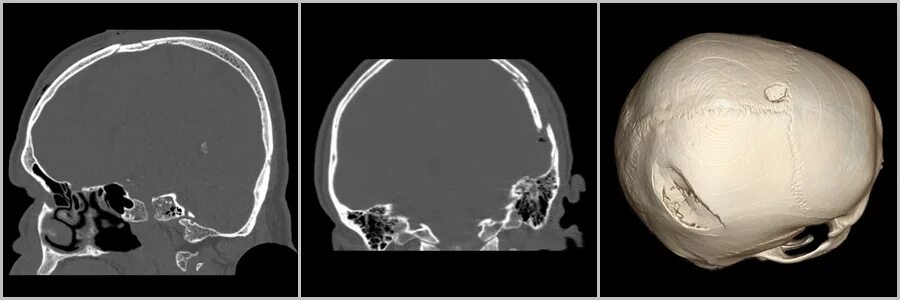 Вдавленный перелом теменной кости кт. Многооскольчатый перелом черепа. Оскольчатый вдавленный перелом свода черепа. Оскольчатый перелом черепа. Оскольчатый перелом черепа.