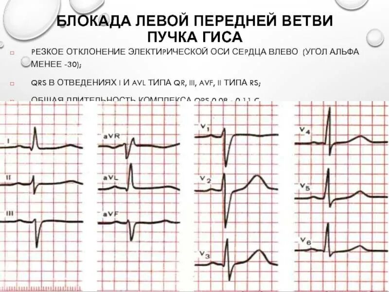 Неполная блокада передней ножки пучка гиса. Блокады ветвей пучка Гиса на ЭКГ. Неполная блокада левой ножки пучка Гиса. Полная блокада левой ножки пучка Гиса на ЭКГ. Блокада правой ножки пучка Гиса на ЭКГ.