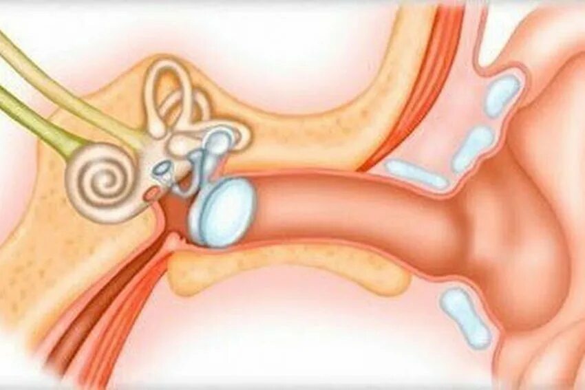 Если уши попало вода пост. Строение уха с попаданием воды. Вода в ухе после купания. Болит ухо после купания. Шунтирование уши попала вода.