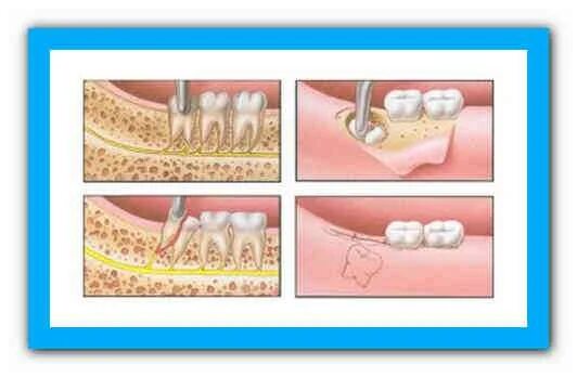 Sau nhổ răng số 8 có cần khâu lại huyệt nhổ răng? Vinmec