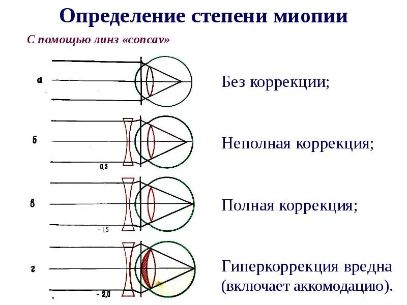 Степени близорукости. Миопия разной степени. Миопия 1 степени. Миопия средней степени.