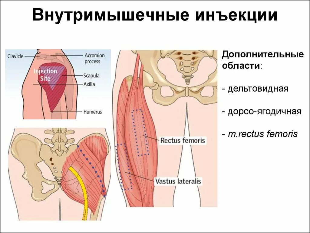 Внутримышечная инъекция. Места для внутримышечных инъекций. Внутримышечный укол. Внутри мышчно инъекция. Гексаред