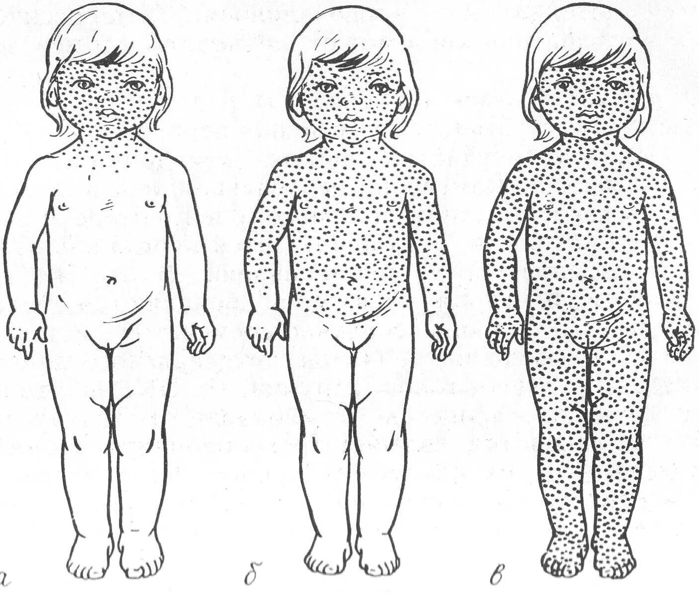Скарлатиноподобная экзантема. Скарлатина локализация сыпи. Ветрянка краснуха скарлатина. Первые элементы сыпи при кори у детей. Корь симптомы у детей лечение инкубационный