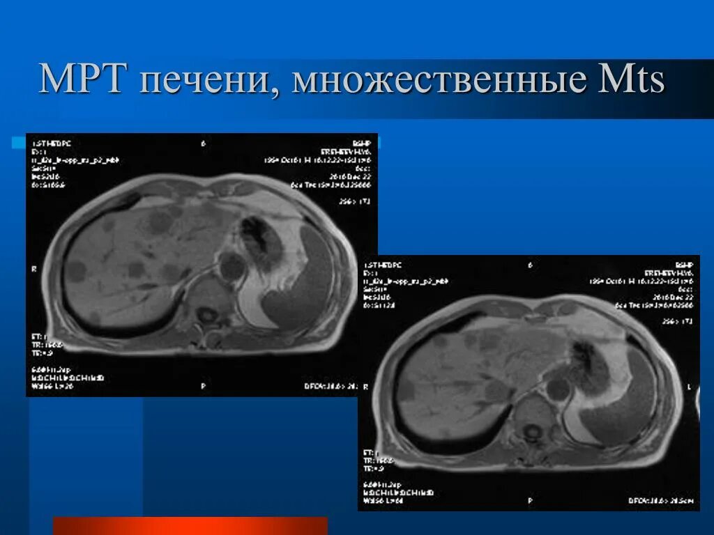 Множественные образования в печени