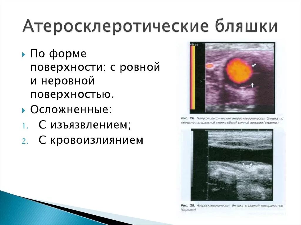 Атеросклеротическая бляшка узи. Гетерогенная атеросклеротическая бляшка. гетерогенная структура атеросклеротической бляшки. типы атеросклеротических бляшек узи.