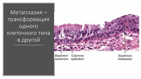 Метаплазия это