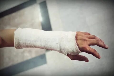 Рука девушки в гипсе