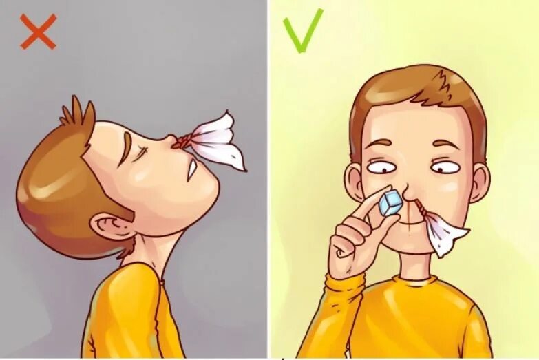 положение при носовом кровотечении. что делать если из головы идет. оказание помощи при кровотечении из носа. положение головы. что делать если кровь из носа.