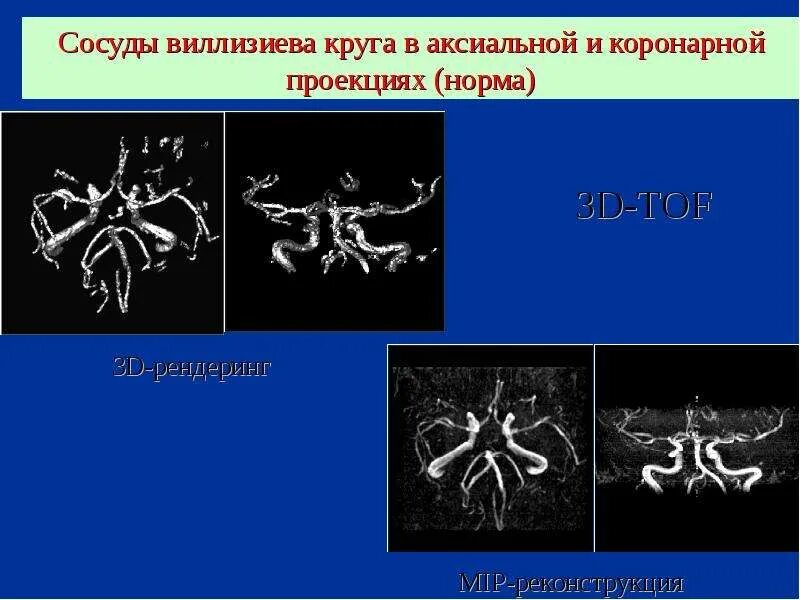 Виллизиев круг вариант развития на мрт. Виллизиев круг на кт. Сосуды Виллизиева круга. Сегменты сосудов Виллизиева круга. Трифуркация Виллизиева круга.