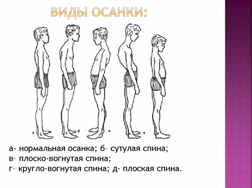 Вогнуто круглая спина. Вогнуто круглая спина. Округло вогнутая спина. Круглая спина разновидность осанки. Плоская спина.