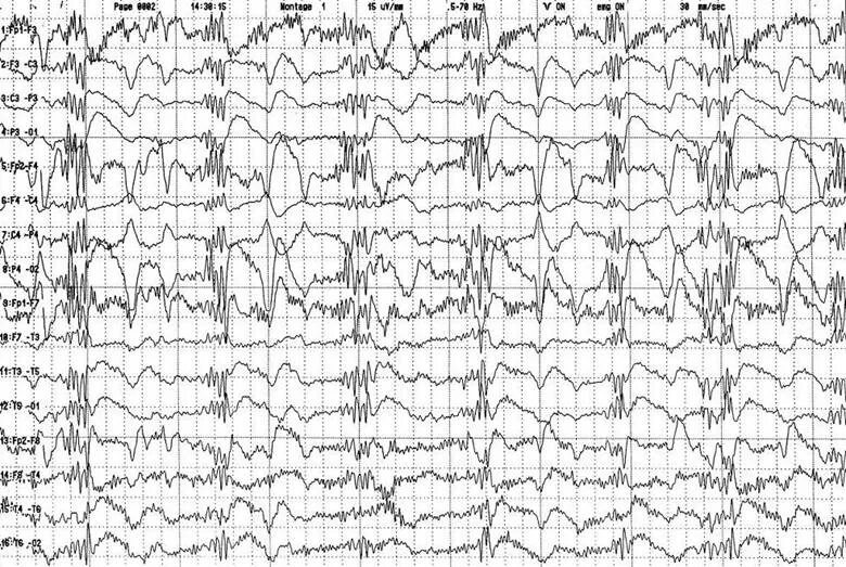 Ээг сигнал. Артефакт ЭКГ на ЭЭГ. Что такое электроэнцефалография ЭКГ. ЭЭГ при БКЯ.