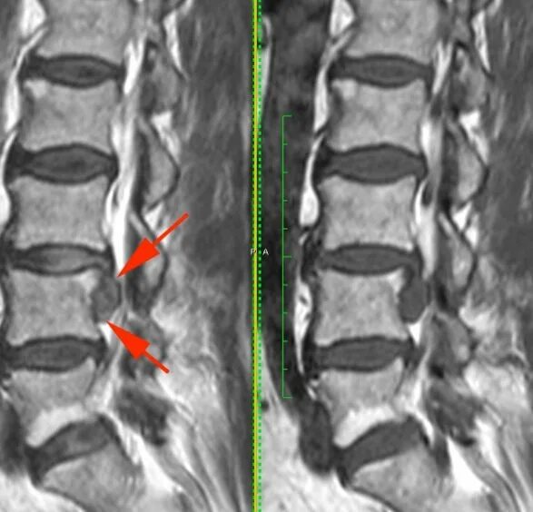 Протрузия дисков на уровне l4 l5. Грыжа диска l2-l3. Экструзии дисков l3-s1. Центральная экструзия диска l2-l3. Грыжа дисков l2-l3.