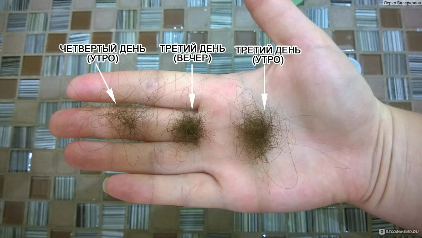 Норма выпадения волос при мытье. Норма выпадения волос. НАРИА выпадения волос в день. Норма выпадения волос у женщин. Еорма выпадений волос в день.