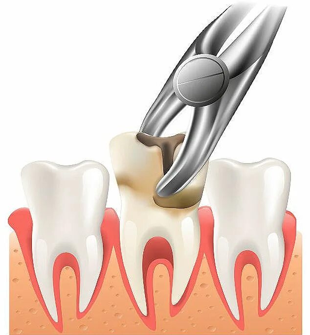 Удаление зуба. Вырывание коренного зуба.