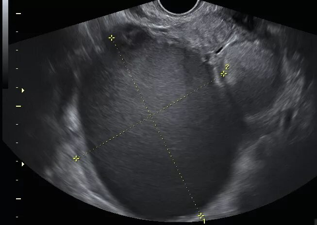 Эндометриоидная киста яичника. Эндометриоидные кисты яичника. Эндометриоидные кисты яичника на УЗИ. Эндометриома яичника на УЗИ. Эндометриоз виден на узи