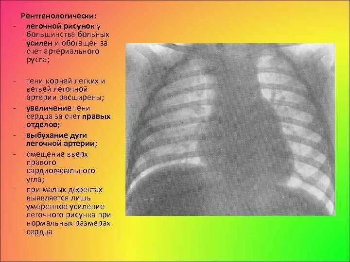 Легочный рисунок. Усиление легочного сосудистого рисунка. Легочный рисунок усилен. Легочный рисунок в норме.