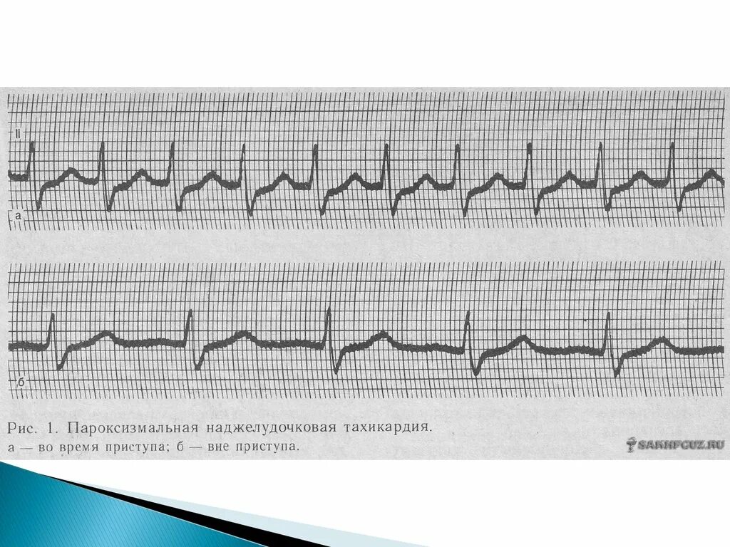 Наджелудочковая пароксизмальная аритмия ЭКГ. Наджелудочковая тахикардия ЧСС. Пароксизмальная тахикардия ЧСС. Пароксизмальная аритмия на ЭКГ.