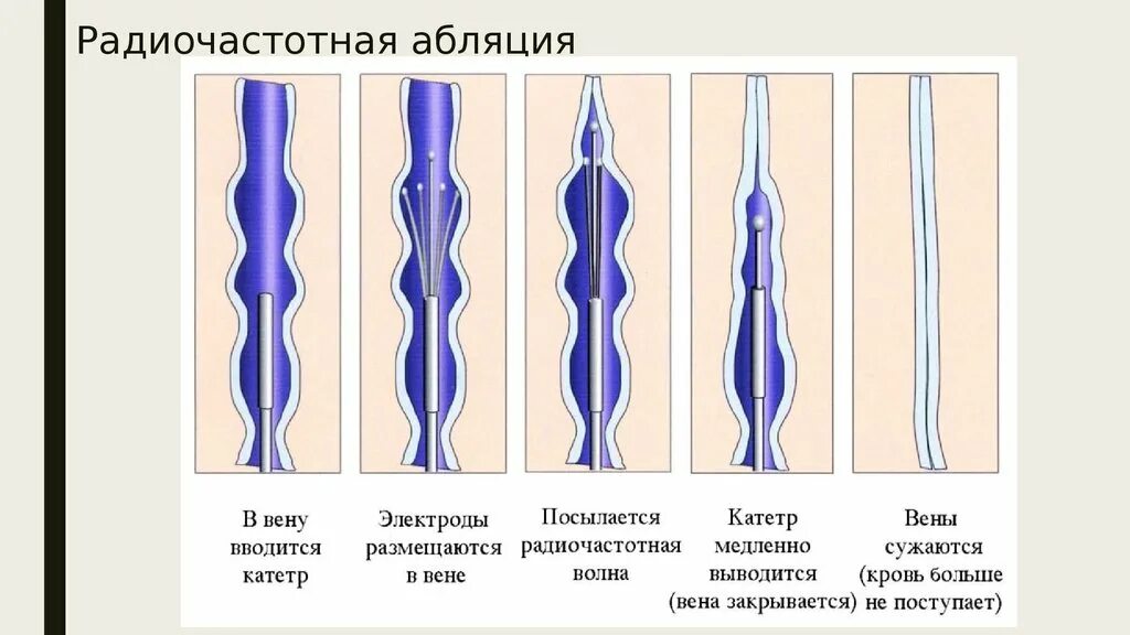 Радиочастотная абляция позвоночника (РЧА). Радиочастотная денервация позвоночника. Радиочастотная катетерная абляция сердца. Катетерная абляция сердца что это такое. Абляция пищевода