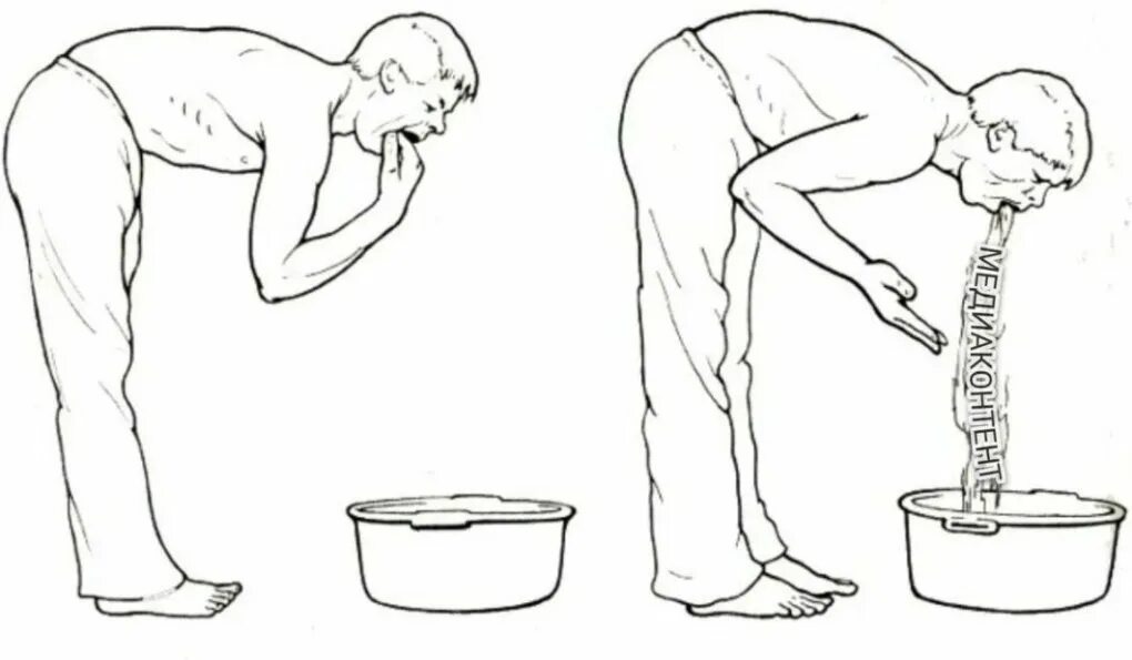 Промывание желудка. Рвота промывание желудка. Беззондовое промывание желудка. Промывание желудка при отравлении. Отравление через воду