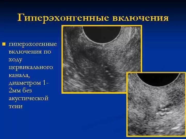 Образование без акустической тени. Гиперэхогенные включения. Гиперэхогенные включения в матке. Гиперэхогенное включение в матке. Гиперэхогенные включения УЗИ.