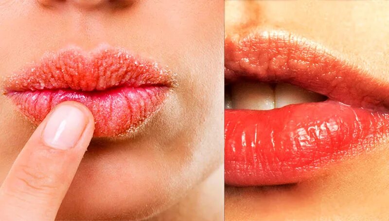 Помада для потрескавшихся губ. Делать губы при температуре. Отек после увеличения губ. Гиповитаминозный хейлит. Делать губы при температуре.