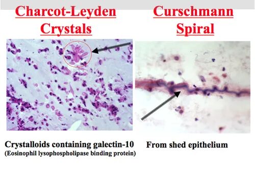 Кристаллы Шарко Лейдена. Кристаллы Шарко-Лейдена в мокроте. Спирали Куршмана и Кристаллы Шарко-Лейдена. Спирали Куршмана, Кристаллы Шарко-Лейдена бронхиальной астме.