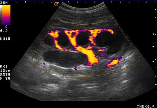 Доплер почек. Гидронефроз допплерография. Гидронефроз почки УЗИ. Допплерография мочевого пузыря. УЗИ почек при гидронефрозе.