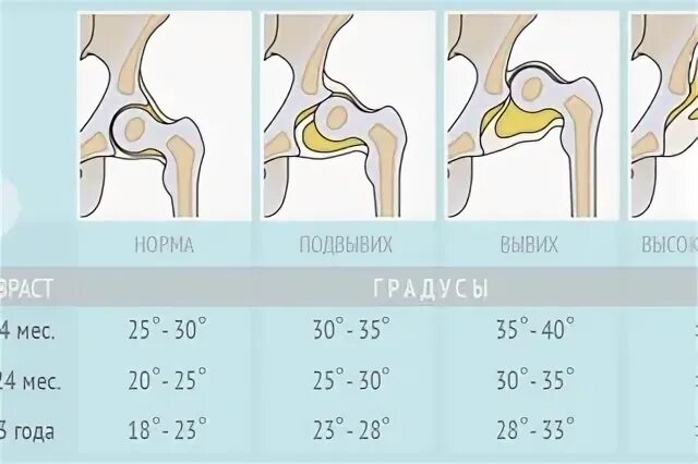 Норма тазобедренного сустава у новорожденных
