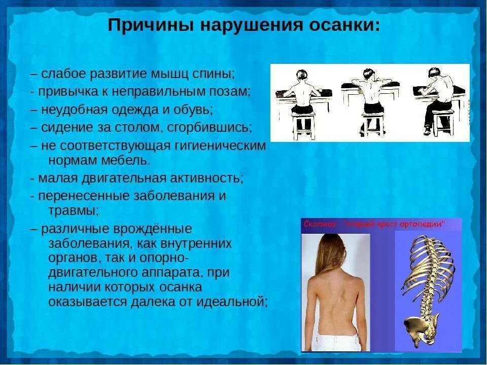 Сколиоз информация. Причины сколиоза у детей дошкольного возраста. осанка и причины ее нарушения. профилактика неправильной осанки. причины ухудшения осанки.