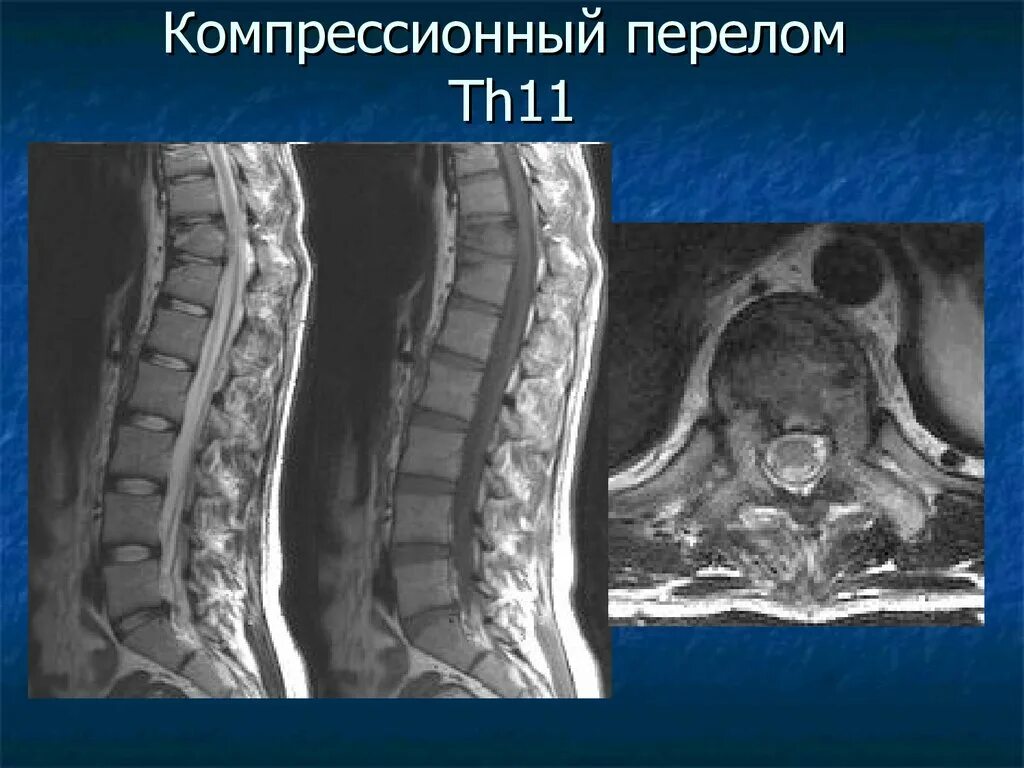 Компрессионный перелом позвоночника th11-l1. Компрессионный перелом th12 позвонка мрт. Компрессионный перелом тела т11 позвонка. Компрессионный перелом 12 позвоночника. Компрессионный перелом тела 1 1