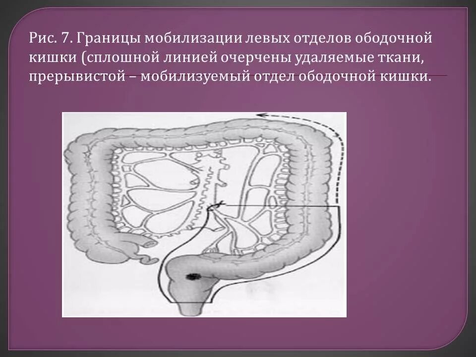 Заболевания ободочной кишки. Операции на толстом кишечнике схема. операции на ободочной кишке. мобилизация ободочной кишки. мобилизация кишечника.