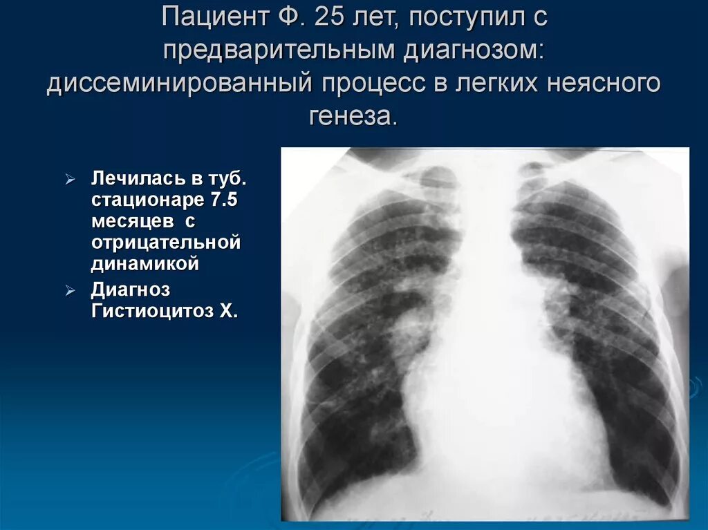 Диссеминированный процесс в лёгких. Диссеминированных процессов в легких. Двусторонняя диссеминация легких.