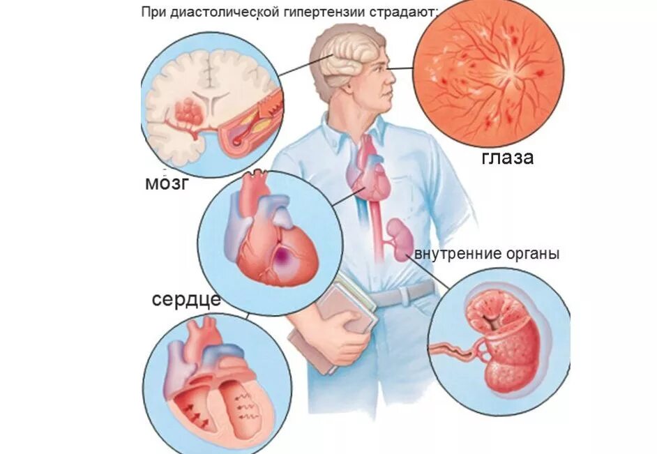 Осложнения артериальной гипертензии. Последствия гипертонии. Гипертензия последствия. Осложнения при гипертонической болезни.