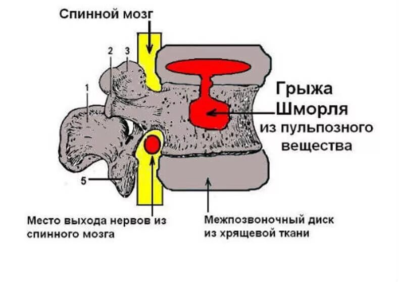 Грыжа мозговых оболочек освобождение нерва. Грыжа Шморля l3 позвонка. L1 грыжа Шморля позвоночника. Единичная грыжа Шморля l2. Th12-l1 позвонков грыжа Шморля.