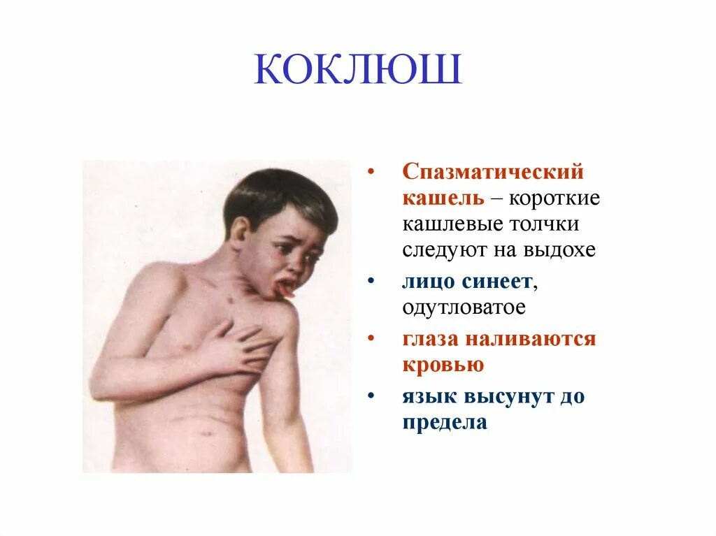 Последствия болезни коклюшем. Основной симптом коклюша. Характерные клинические симптомы коклюша. Спазматический кашель коклюша. Коклюш специфические симптомы.