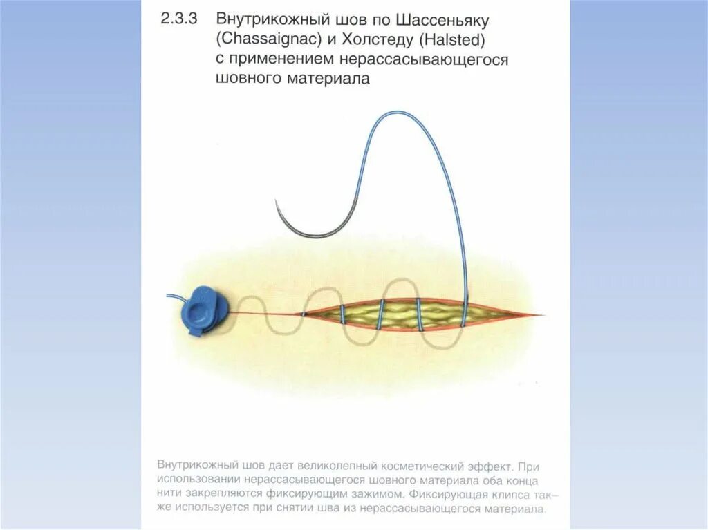 Через сколько рассасываются нити. Стерилизация косметический шов. Шов хирургический внутрикожный. Косметический шов с рассасывающимися нитками. Косметический шов леской.