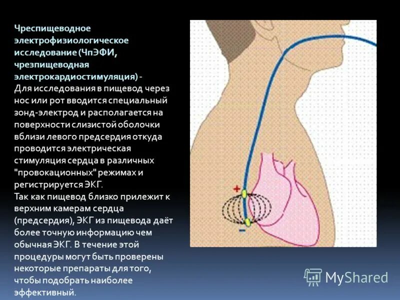 Узи через пищевод. Исследование сердца через нос. Электрофизиологическое исследование сердца. Исследование сердца ЧПЭФИ. Чреспищеводная электрокардиостимуляция предсердий.