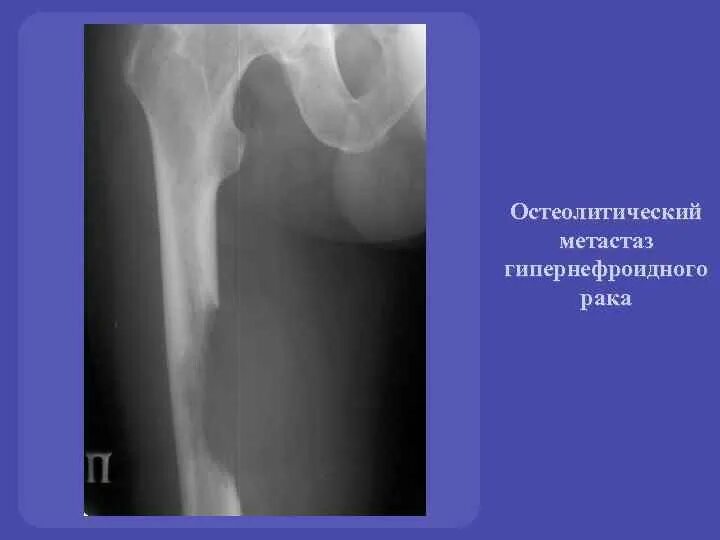 Метастазы в костях при раке предстательной железы. Остеобластические метастазы рентген. остеолитические метастазы рентген. остеолитические метастазы в длинной трубчатой кости. остеобластические метастазы в длинной трубчатой кости.