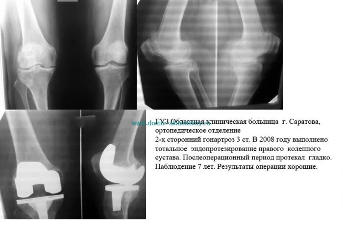 Сколько длится больничный после замены сустава. Одномыщелковое эндопротезирование коленного сустава реабилитация. Эндопротез коленного сустава рентген протокол. Тотальное эндопротезирование коленного сустава УЗИ. Артроз коленного сустава эндопротез.