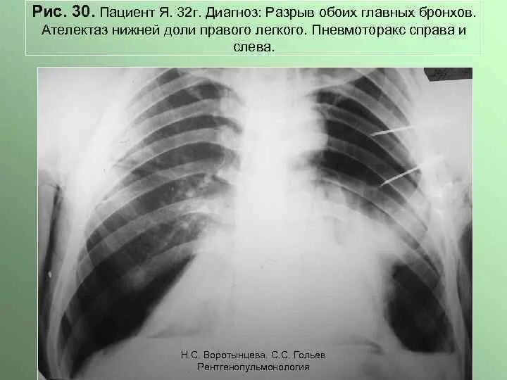 Ателектаз s6 правого легкого рентген. Ателектаз верхней доли справа рентген. Ателектаз верхней доли рентген. Ателектаз средней доли правого легкого рентген. Ателектаз нижнего легкого