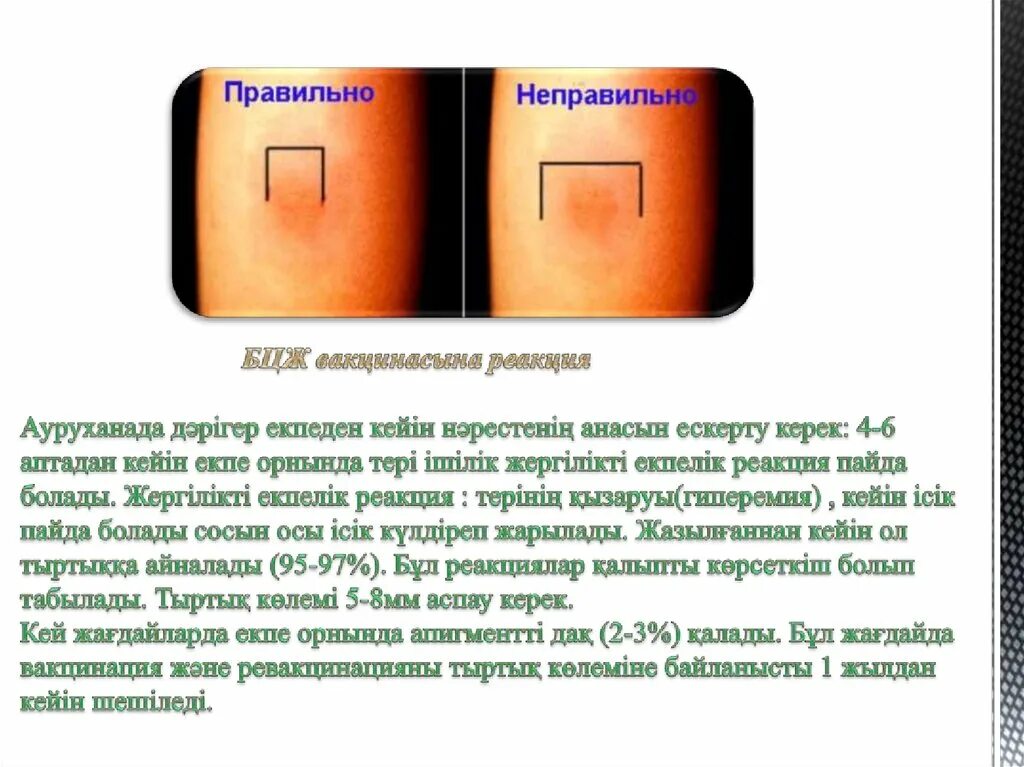 Бцж вакцина реакция. БЦЖ В 7 лет реакция норма. БЦЖ стадии развития реакции.