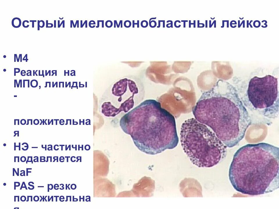 Резко положительная реакция. Острый миеломонобластный лейкоз м4. Острый промиелоцитарный лейкоз картина крови. Недифференцированный лейкоз картина крови. Острый недифференцированный лейкоз.