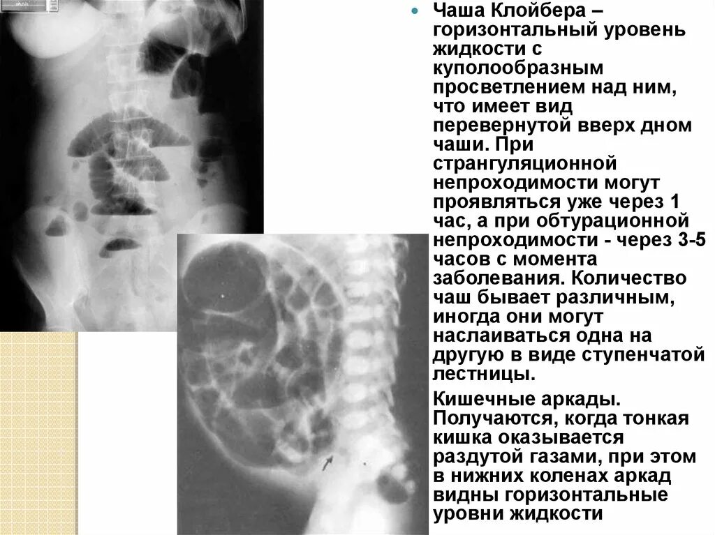 Симптом чаши. Кишечная непроходимость чаши клойбера. толстокишечные чаши клойбера. чаши клойбера при кишечной непроходимости. чаши клойбера и уровни жидкости.
