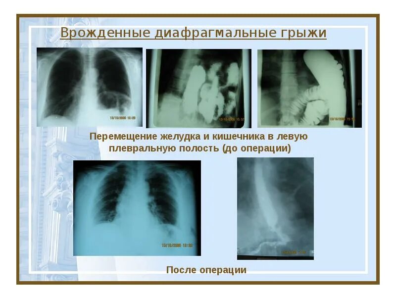 Диагностика диафрагмальной грыжи. Ложная диафрагмальная грыжа рентген. грыжа купола диафрагмы рентген. ложная грыжа диафрагмы рентген. рентгенологическая картина травматической диафрагмальной грыжи.