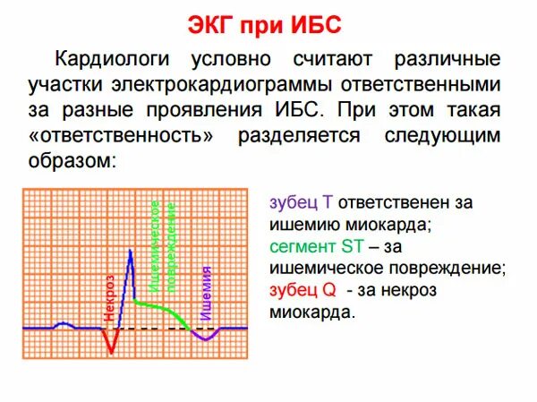 Ишемия боковой стенки. ЭКГ при хронической ишемической болезни сердца. Ишемия сердца на ЭКГ. Изменения на ЭКГ при ишемической болезни сердца. ЭКГ при хронической ИБС.