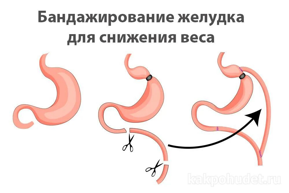 Как называется операция на желудок. Операция по уменьшению желудка. кольцо на желудок для похудения. бандажирование желудка. бариатрическая операция на желудке.