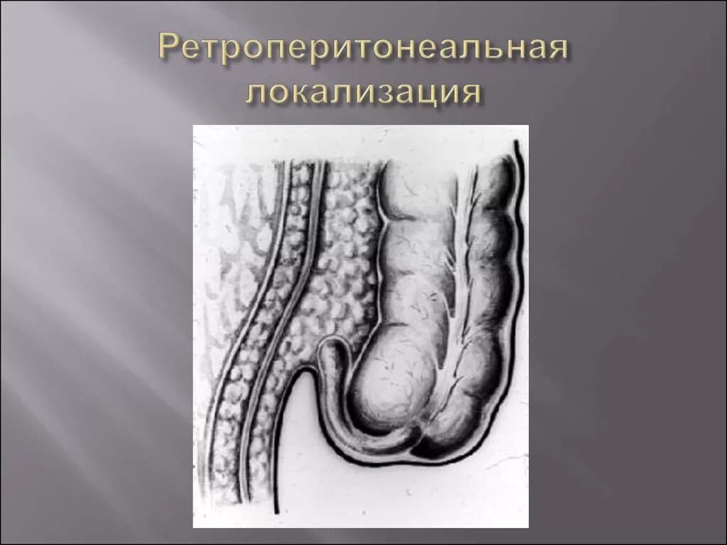 Ретроцекальный аппендицит аппендэктомия. Ретроцекальный аппендицит расположение. Ретроперитонеальное аппендицит. Ретроцекальный острый аппендицит. Локализация острого аппендицита