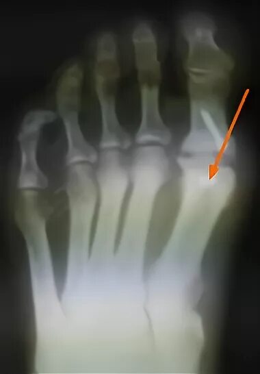 асептический некроз таранной кости голеностопного сустава мрт. асептический некроз костей стопы. асептический некроз костей стопы. энхондрома пяточной кости. таранная кость асептический некроз.